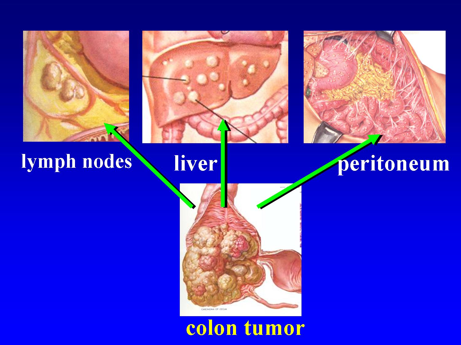 Hipec ovhipec pmp peritoneal cancer peritoneum seeding seedings